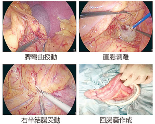 図2：潰瘍性大腸炎に対する腹腔鏡下大腸全摘術＋回腸嚢肛門吻合