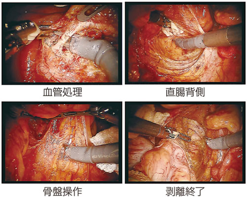 図3：ロボット支援下直腸切除術