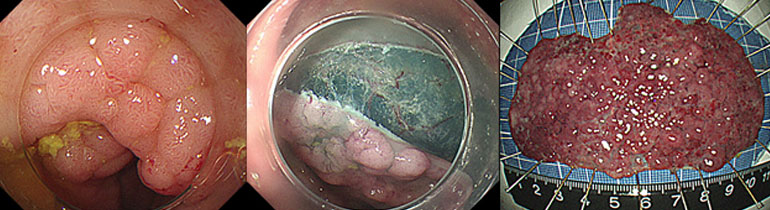 図2.大腸腫瘍に対する内視鏡的粘膜下層剥離術