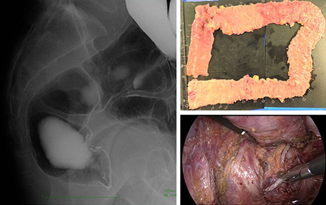 図3.直腸癌を伴う家族性大腸ポリポーシスに対する大腸全摘術