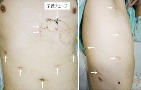 図2.腹腔鏡下手術の腹部創(左)と胸腔鏡下手術の胸部創(右)
