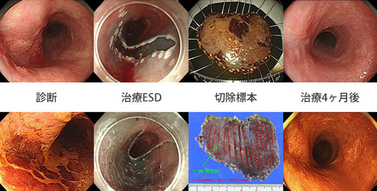 図3.食道癌に対する内視鏡的粘膜下層切除(ESD)