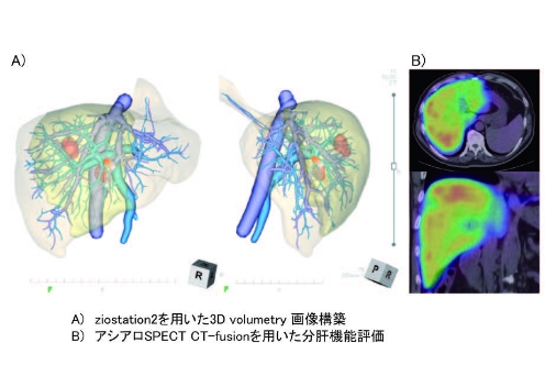 図3：機能的肝体積に基づいた術前手術手技シミュレーション