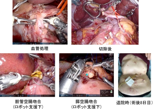 図3：ロボット支援下膵頭十二指腸切除術