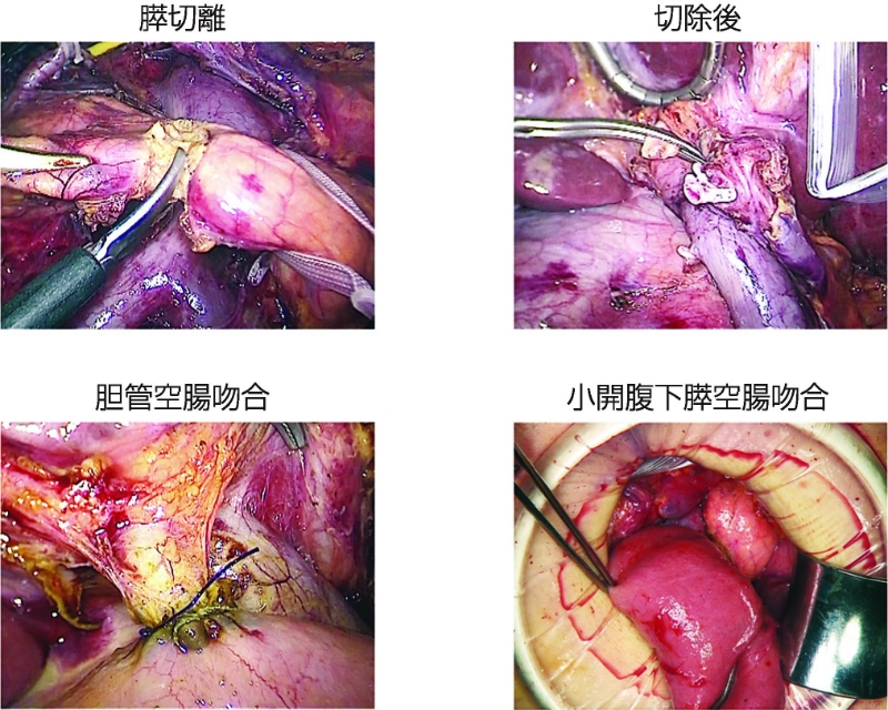 図16：腹腔鏡下膵頭十二指腸切除術