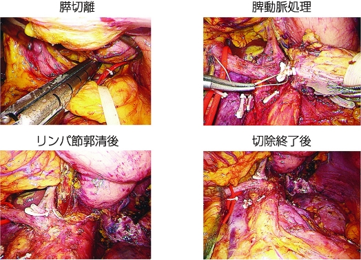 図17：膵癌に対する腹腔鏡下尾側膵切除