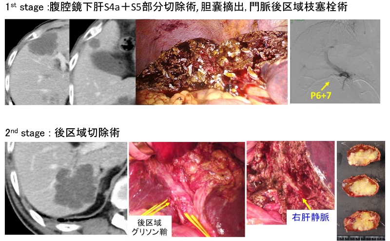 図8：大腸癌肝転移に対するTwo-stage hepatectomy​