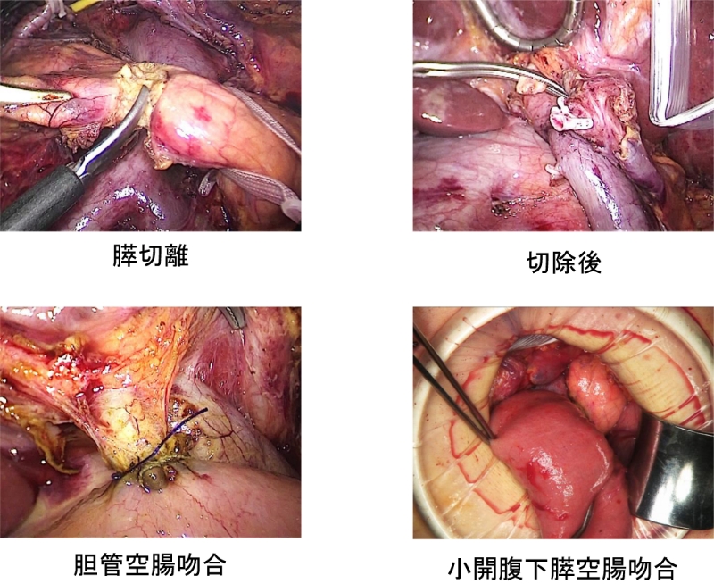 図12：腹腔鏡下膵頭十二指腸切除術