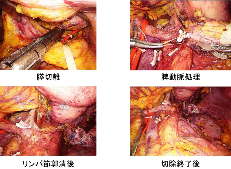 図13：膵癌に対する腹腔鏡下尾側膵切除