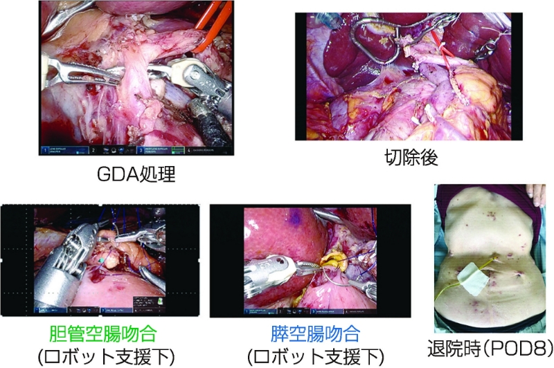 図18：ロボット支援下膵頭十二指腸切除術
