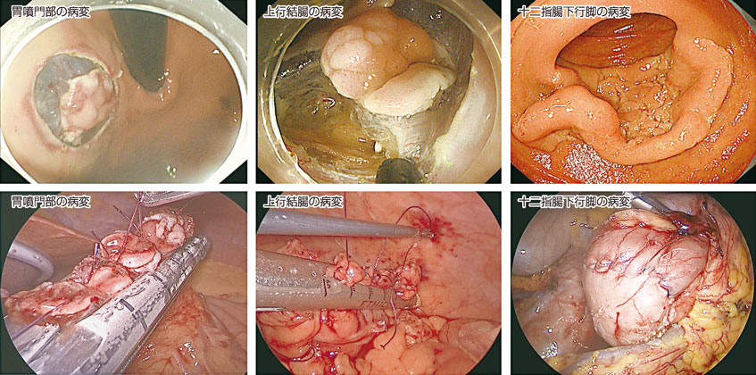 図2：腹腔鏡・内視鏡合同手術(LECS)