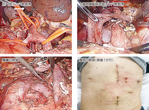 図3：腹腔鏡下膵頭十二指腸切除術