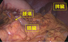 図13.完全腹腔鏡下膵体尾部切除術1