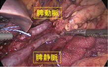 図13.完全腹腔鏡下膵体尾部切除術2