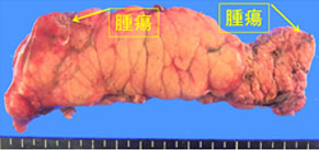 図13.完全腹腔鏡下膵体尾部切除術3