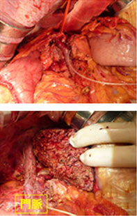 図17.広範囲胆管癌に対する右肝切除術＋亜全胃温存膵頭十二指腸切除術2