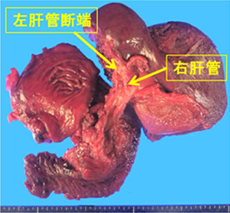 図17.広範囲胆管癌に対する右肝切除術＋亜全胃温存膵頭十二指腸切除術3